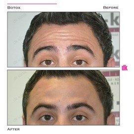 BOTOX - Man - Before and After