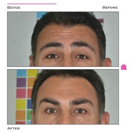 BOTOX - Man - Before and After