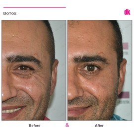 BOTOX - Man - Before and After