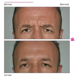 BOTOX - Man - Before and After