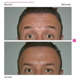 BOTOX - Man - Before and After