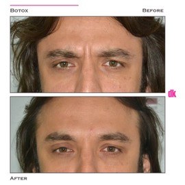 BOTOX - Man - Before and After