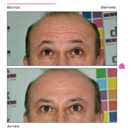 BOTOX - Man - Before and After