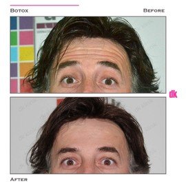 BOTOX - Man - Before and After