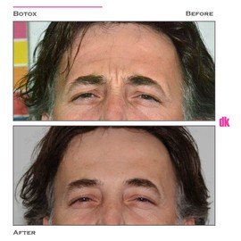 BOTOX - Man - Before and After