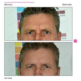 BOTOX - Man - Before and After