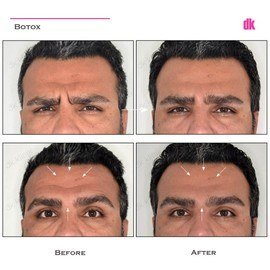 BOTOX - Man - Before and After