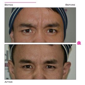 BOTOX - Man - Before and After