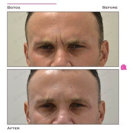 BOTOX - Man - Before and After
