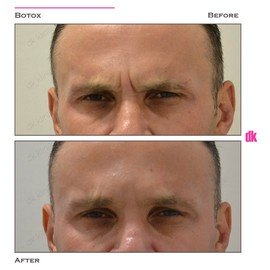 BOTOX - Man - Before and After