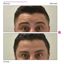 BOTOX - Man - Before and After