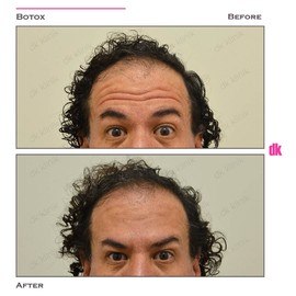 BOTOX - Man - Before and After