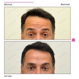 BOTOX - Man - Before and After