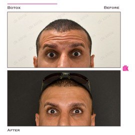 BOTOX - Man - Before and After