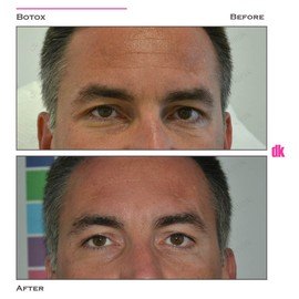 BOTOX - Man - Before and After