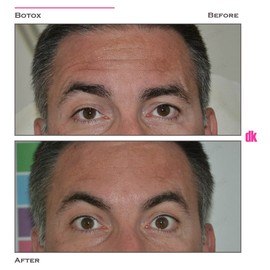 BOTOX - Man - Before and After