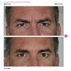 BOTOX - Man - Before and After
