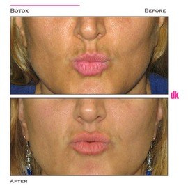 BOTOX - Upper Lips - Before and After