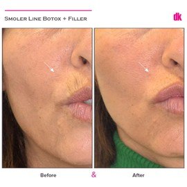 BOTOX - Upper Lips - Before and After