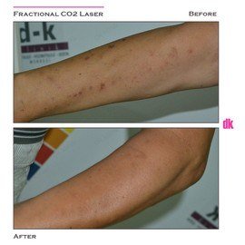 SKIN SPOT TREATMENT - Before and After