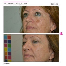 SKIN SPOT TREATMENT - Before and After