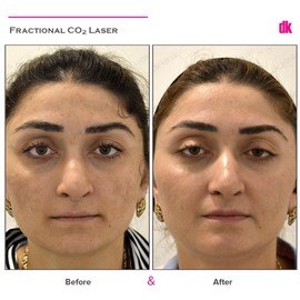 SKIN SPOT TREATMENT - Before and After