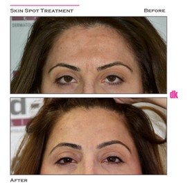 SKIN SPOT TREATMENT - Before and After