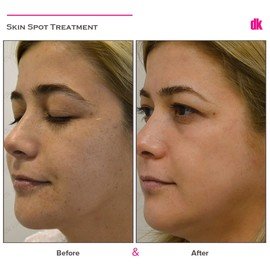 SKIN SPOT TREATMENT - Before and After