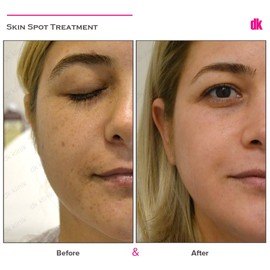 SKIN SPOT TREATMENT - Before and After
