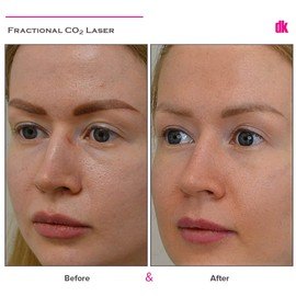 SKIN SPOT TREATMENT - Before and After