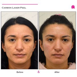 SKIN SPOT TREATMENT - Before and After