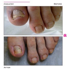 FOOT AND NAIL CARE - Before and After