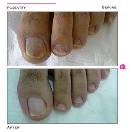 FOOT AND NAIL CARE - Before and After