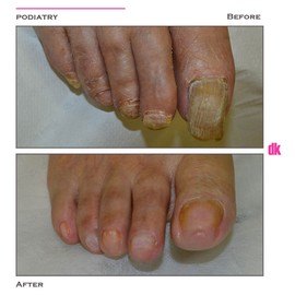 FOOT AND NAIL CARE - Before and After