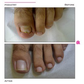 FOOT AND NAIL CARE - Before and After