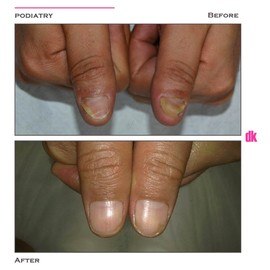 FOOT AND NAIL CARE - Before and After