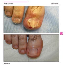 FOOT AND NAIL CARE - Before and After
