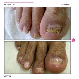 FOOT AND NAIL CARE - Before and After