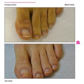 FOOT AND NAIL CARE - Before and After