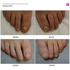 FOOT AND NAIL CARE - Before and After