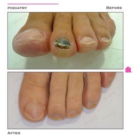 FOOT AND NAIL CARE - Before and After