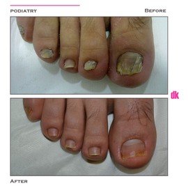 FOOT AND NAIL CARE - Before and After
