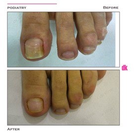FOOT AND NAIL CARE - Before and After