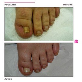FOOT AND NAIL CARE - Before and After
