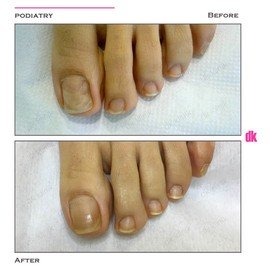 FOOT AND NAIL CARE - Before and After