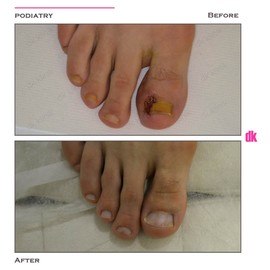 FOOT AND NAIL CARE - Before and After