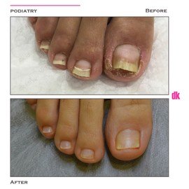 FOOT AND NAIL CARE - Before and After