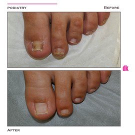 FOOT AND NAIL CARE - Before and After