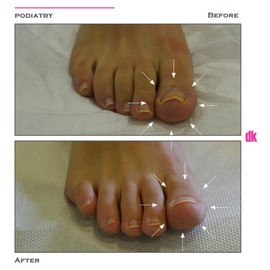 FOOT AND NAIL CARE - Before and After
