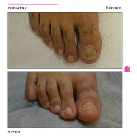 FOOT AND NAIL CARE - Before and After